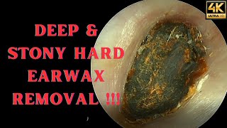 DEEP \& Stony HARD Earwax Removal (Very Satisfying Video)