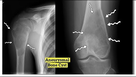 Aneurysmal Bone Cysts Overview