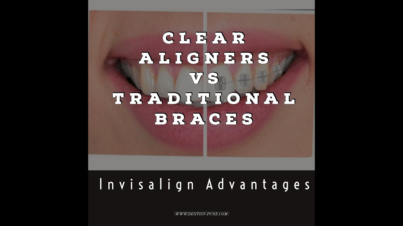 Clear Aligners vs Traditional Braces | Advantage of Invisalign Clear ...