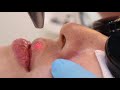 AOKLINIK Lip Plumping with FOTONA LASERS SYSTEMS