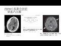 照井塾オンライン第4回 PDPHの長期予後