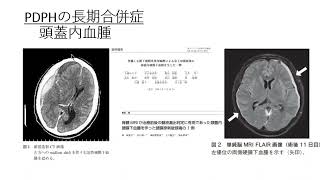 照井塾オンライン第4回 PDPHの長期予後