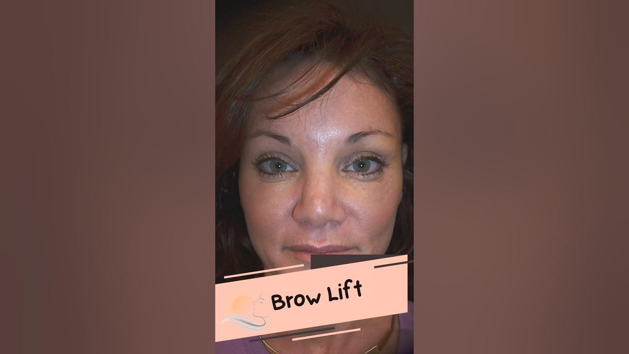 Endoscopic Brow Lift YouTube