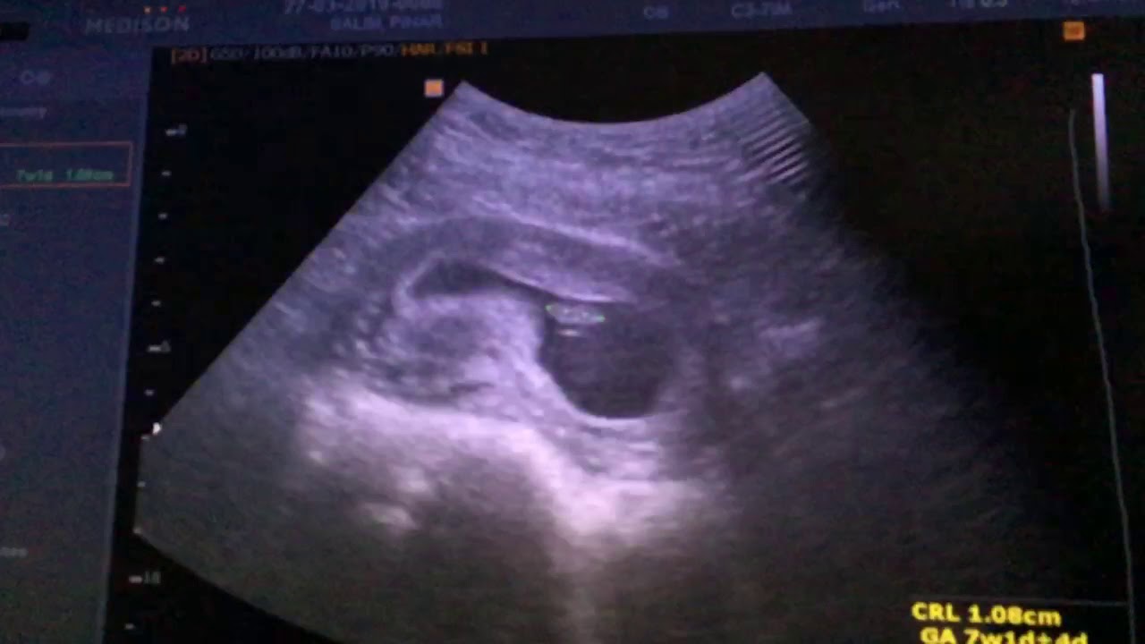 6 haftalik gebelik ultrason goruntuleri youtube