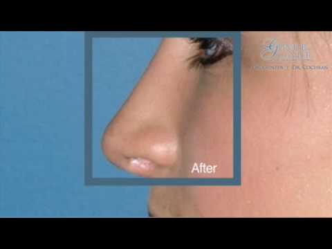 Video thumbnail: Rhinoplasty - Is Nose Job Surgery Right for You? | Dr. Cochran - Dallas, Texas
