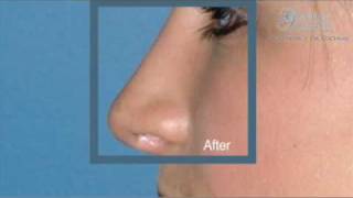Rhinoplasty - Is Nose Job Surgery Right for You? | Dr. Cochran - Dallas, Texas