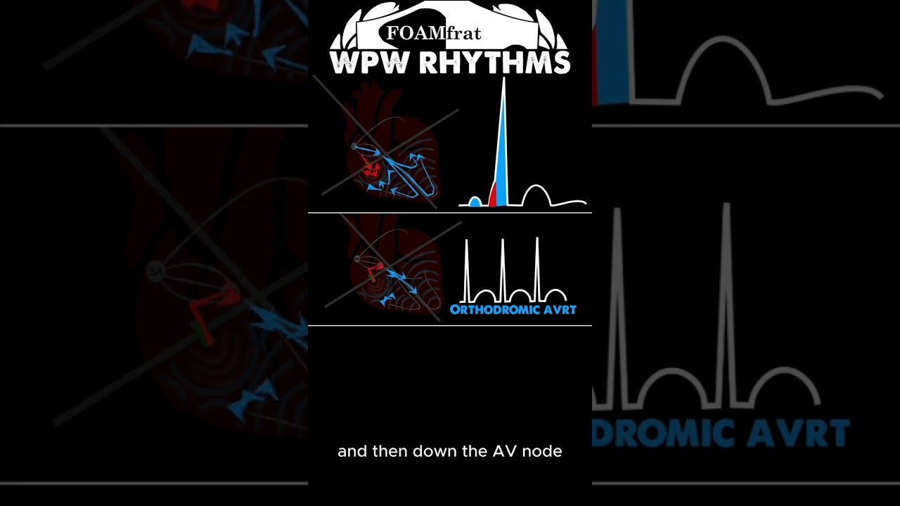 World Parkinson White (WPW) ECG