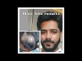 Hairline design  dr sandeep mahapatra  bangalore