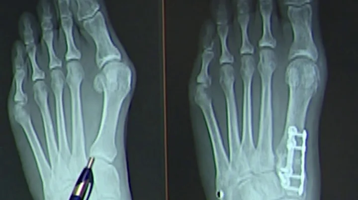 Healthcast: New bunion surgery cuts recovery time - DayDayNews