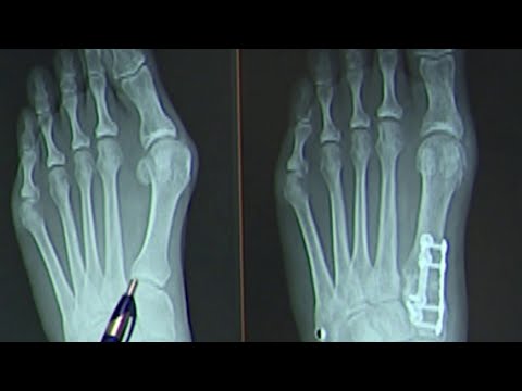 Video: Hoe te herstellen van een voetoperatie (met afbeeldingen)