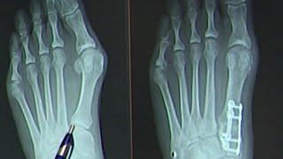 Healthcast: New bunion surgery cuts recovery time