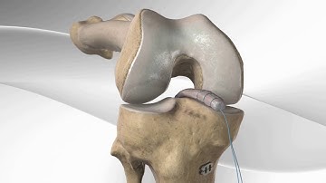 Inlay PCL Reconstruction with Arthrex® PCL TightRope®