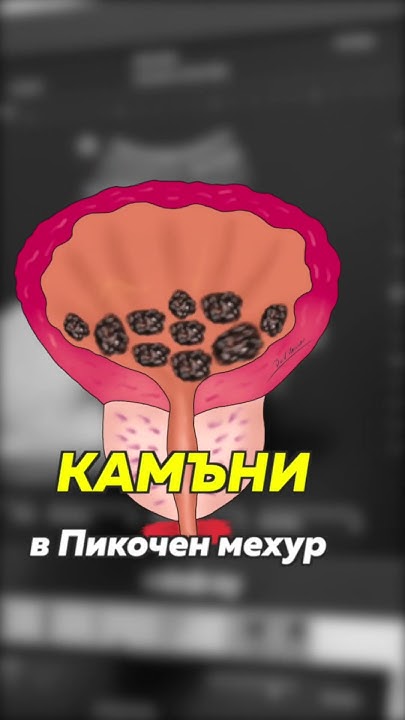 15 камъка в пикочния мехур! (1-ва част) #shorts - YouTube