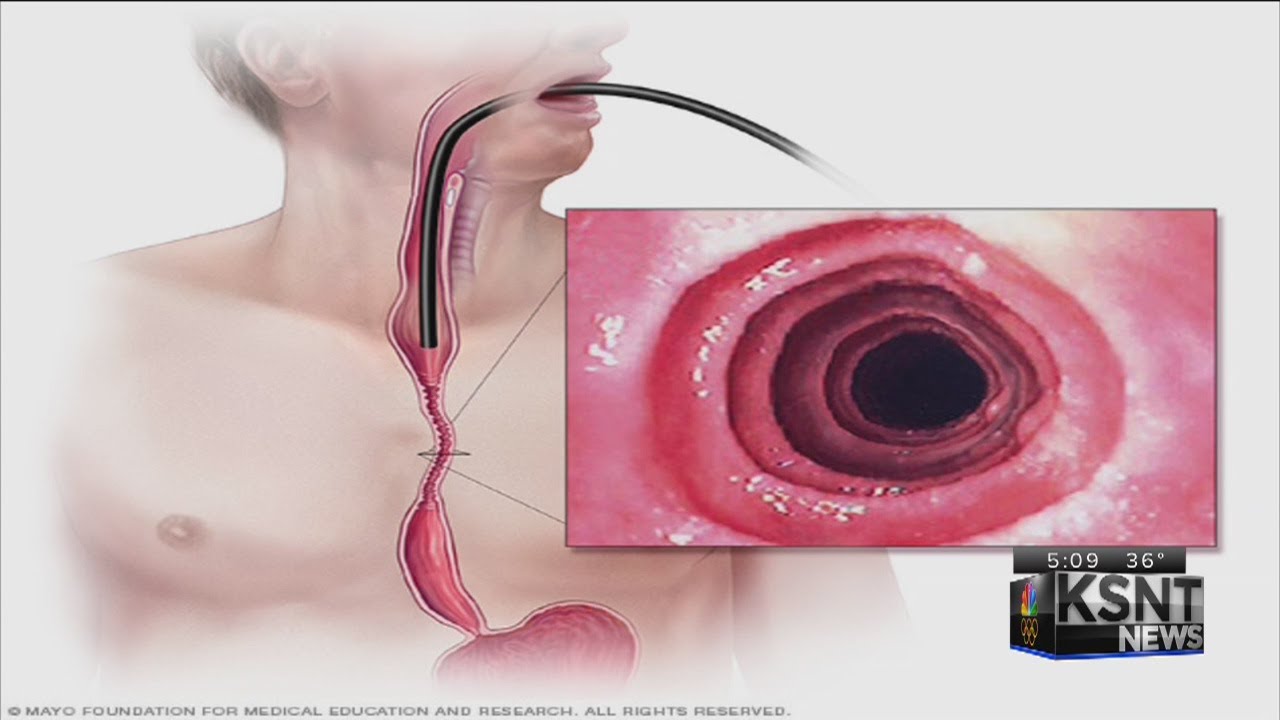 Topeka woman battles new choking disorder