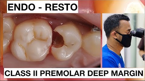 Step by Step Endo Resto Upper Premolar Class II | General Dentist Griya RR