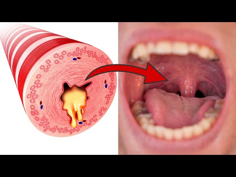 Video: Wie bekomme ich schmelzbare Materia?