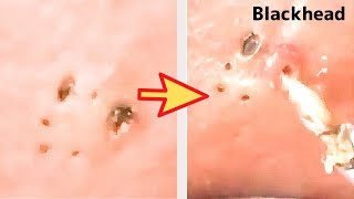 【角栓除去】大物！大量のニキビを芯出しするのって気持ちいい／Blackhead Removal Show screenshot 1