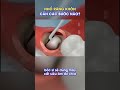 Các bước nhổ răng khôn (răng số 8) 🦷