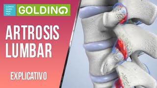 Artrosis Lumbar. 3 estrategias para mejorar la salud de la espalda y mantenerla sana