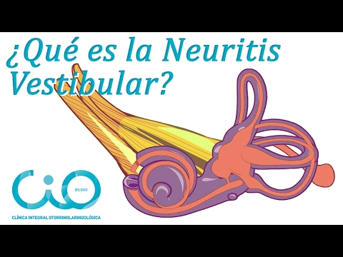 ¿Neuritis vestibular? ¿Vértigo?