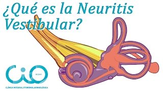¿Neuritis vestibular? ¿Vértigo? | Otorrinos CIO Bilbao