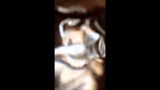 Air Bubble In Eye