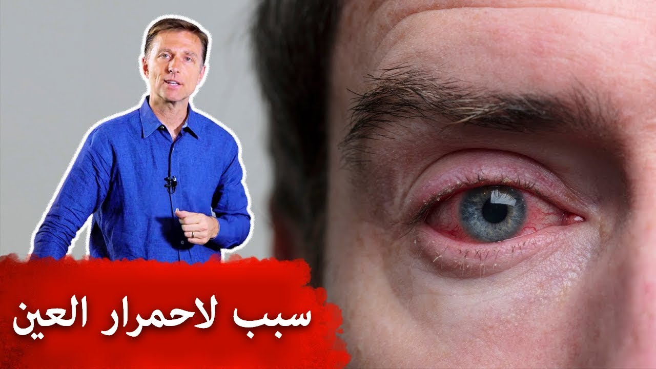 احمرار العين وتشقق الشفاه والأنف الدهني هي أعراض لنقص هذا الفيتامين الهام