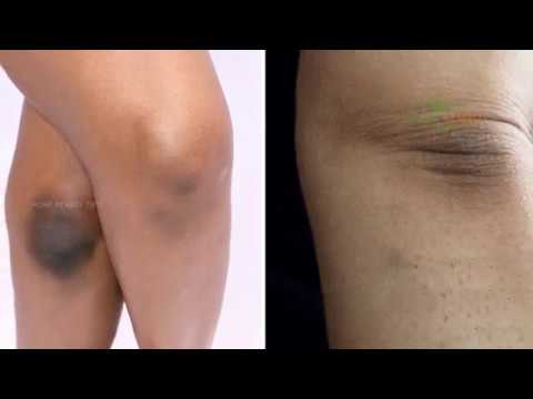 Natural Tricks to Remove Dark Skin Knees and Elbows - Home Remedy Tips