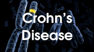 Crohn's Disease - Autoimmune Diseases