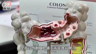大腸直腸癌治療新利器，3D立體腹腔鏡手術