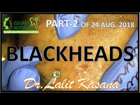 ANTI-ACNE THERAPY/COMEDONE EXTRACTION PART-(Aug.) by Dr.Lalit Kasana