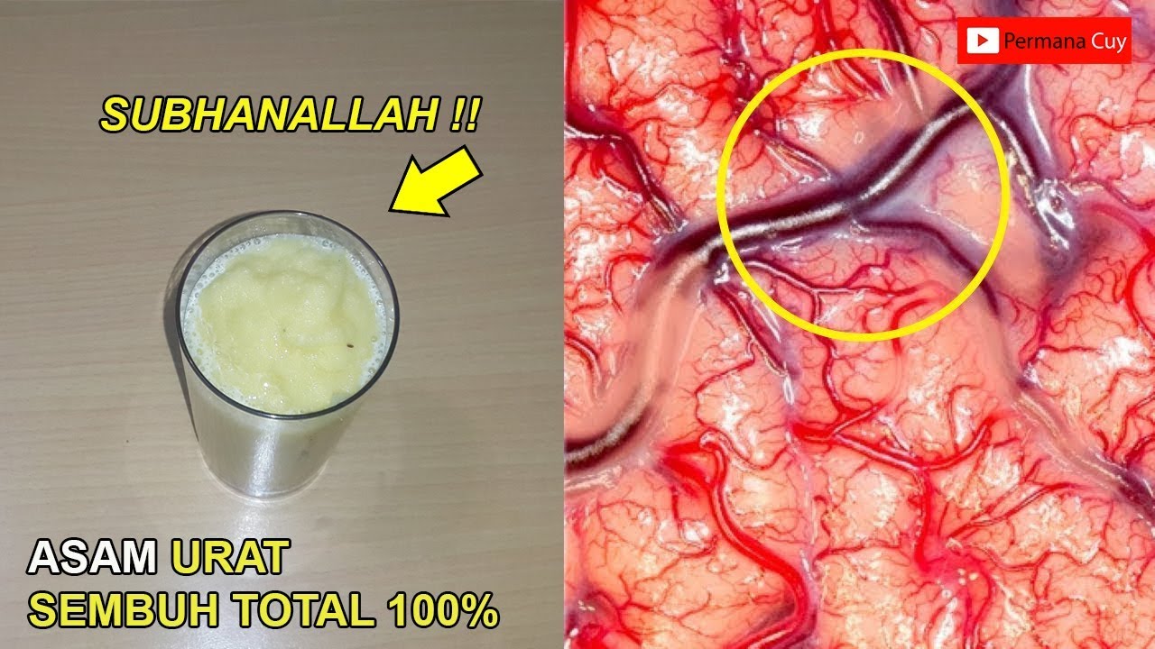 Katakan Selamat Tinggal Pada Asam Urat 