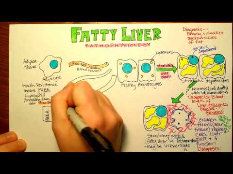 Fatty Liver Pathophysiology