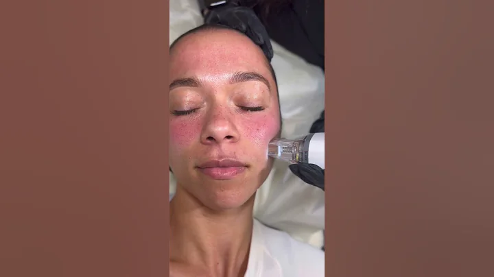 Potenza RF Microneedling at SEV Laser