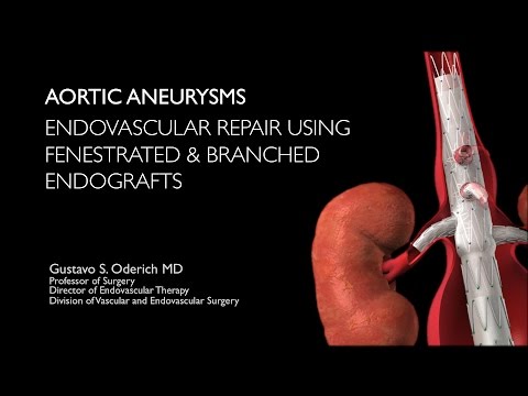Aortic aneurysm treatment with endovascular fenestrated and branched stent-grafts