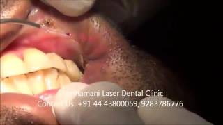 Thumbnail of Laser Treatment Video for Oral submucous Fibrosis Part  3