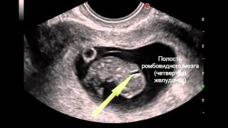 7   Ультразвуковая анатомия плода в I триместре беременности