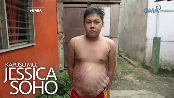 Kapuso Mo, Jessica Soho: Binata sa Cebu, may lumolobong stretchmarks?