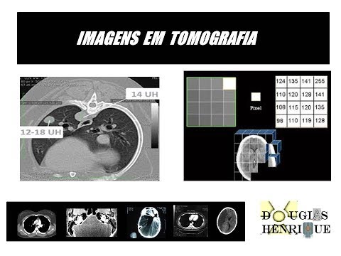 Vídeo: Imagem No Câncer De Mama: Tomografia Computadorizada Com Fóton único E Tomografia Com Emissão De Pósitrons