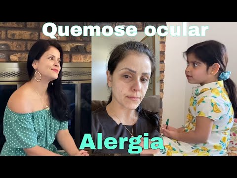 QUEMOSE OCULAR 😳 o que é e como peguei? Relato sobre minha alergia à primavera, cachorros e gatos