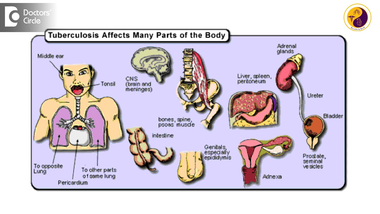 Поражаемые органы туберкулеза. Туберкулез других органов и систем. Туберкулез разных органов. Туберкулез внутренних органов. Туберкулез поражает органы.
