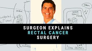 Surgeon Explains Rectal Cancer Surgery