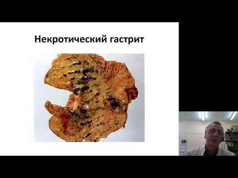 Патанатомия 10. Болезни ЖКТ