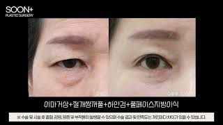 순플러스 전후영상 🔍 이마거상+절개쌍꺼풀+하안검+풀페이스지방이식 오른쪽눈 (8개월차)