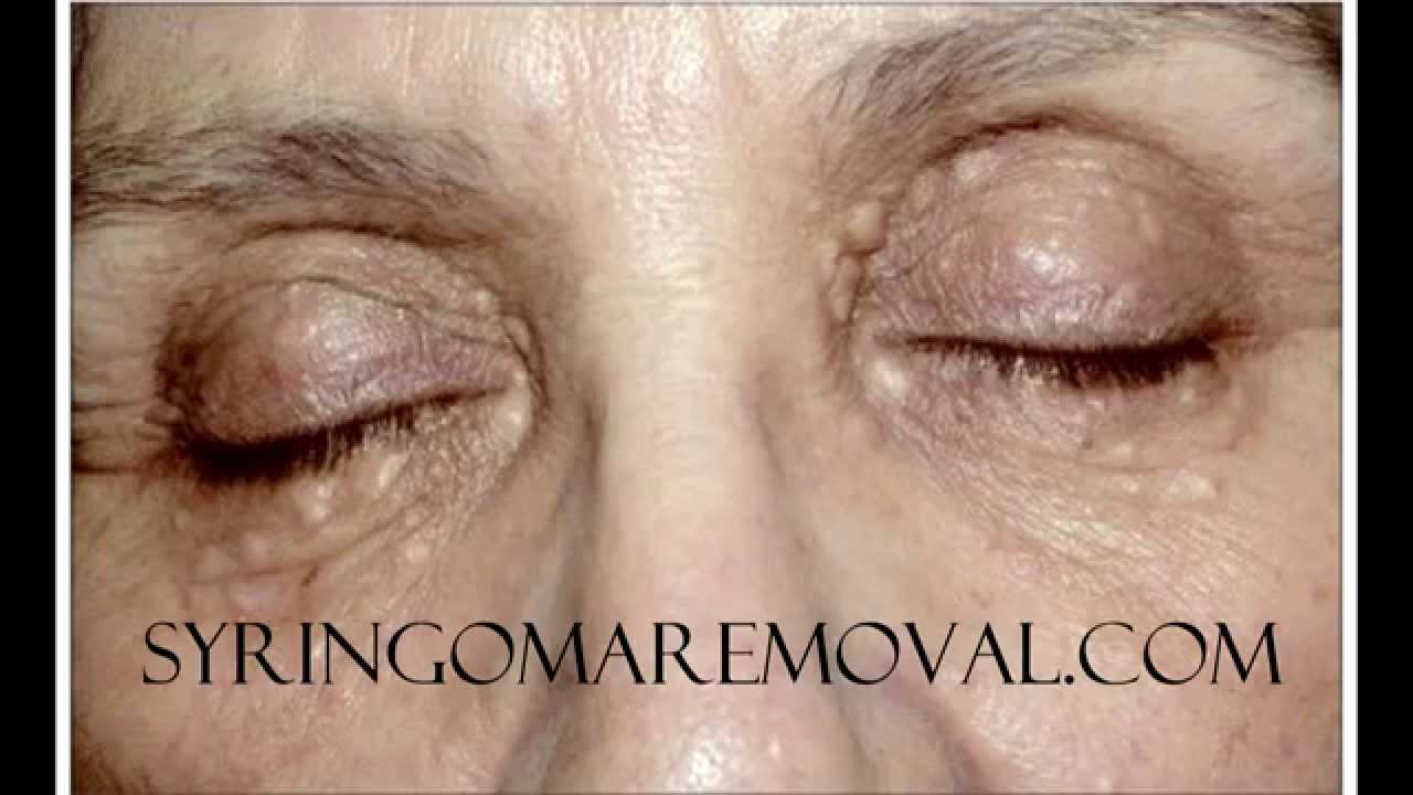 Syringomas recurrence YouTube