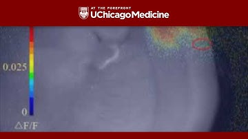 Proof of Corticothalamocortical Loop in Somatosensory Pathway
