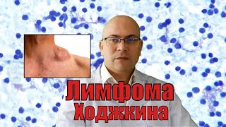 Лимфома Ходжкина: симптомы лимфогранулематоза у взрослых