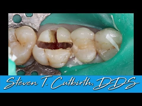 Sectioning and Extraction of Maxillary First Molar - Dental Minute with Steven T. Cutbirth, DDS