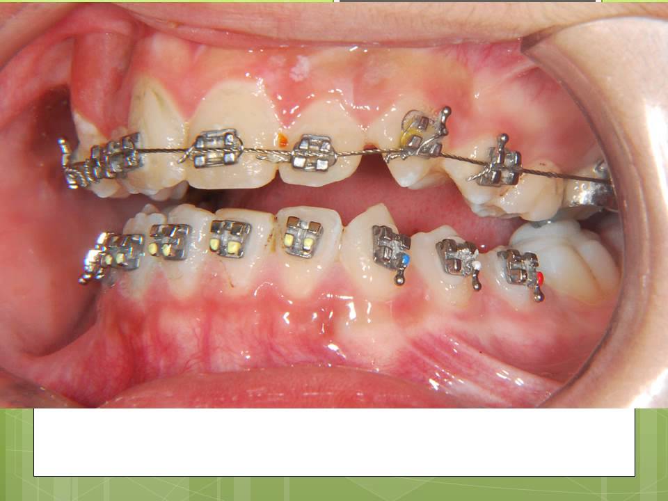 deep bite bite turbos YouTube