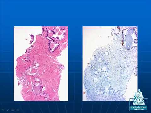 07 Problematiche anatomo-patologiche  nelle patologie prostatiche. Enrico Betri